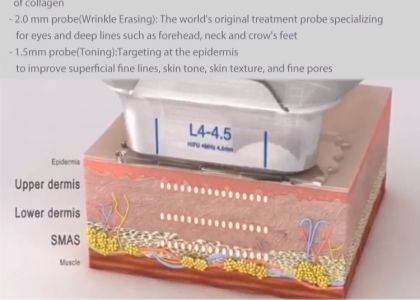 7D HIFU Tighten the skin